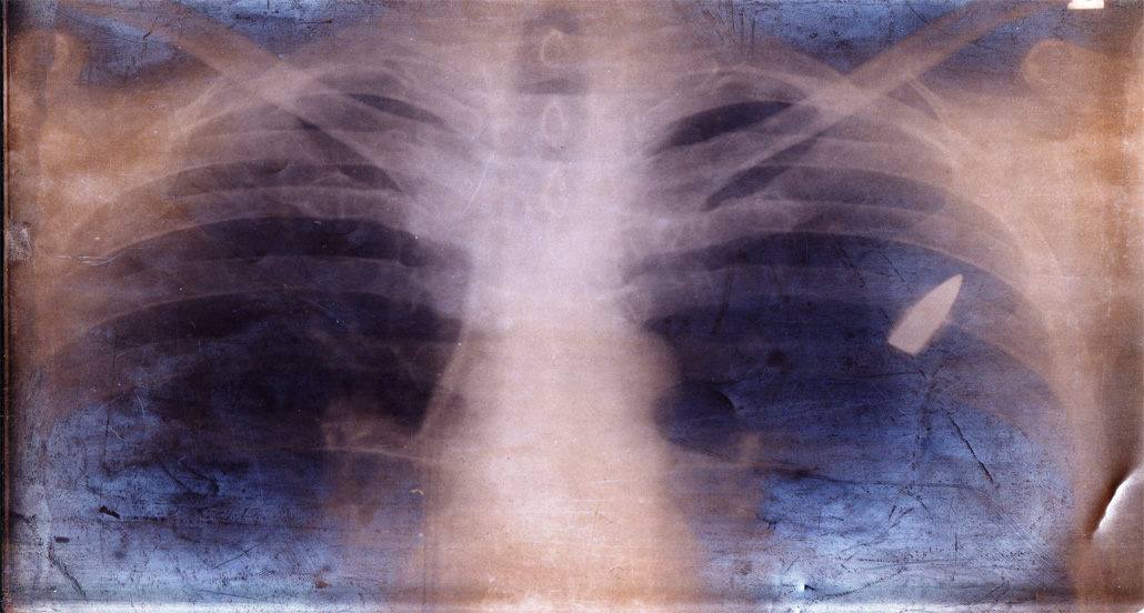 Gallipoli veteran Eric Beamish X-Ray